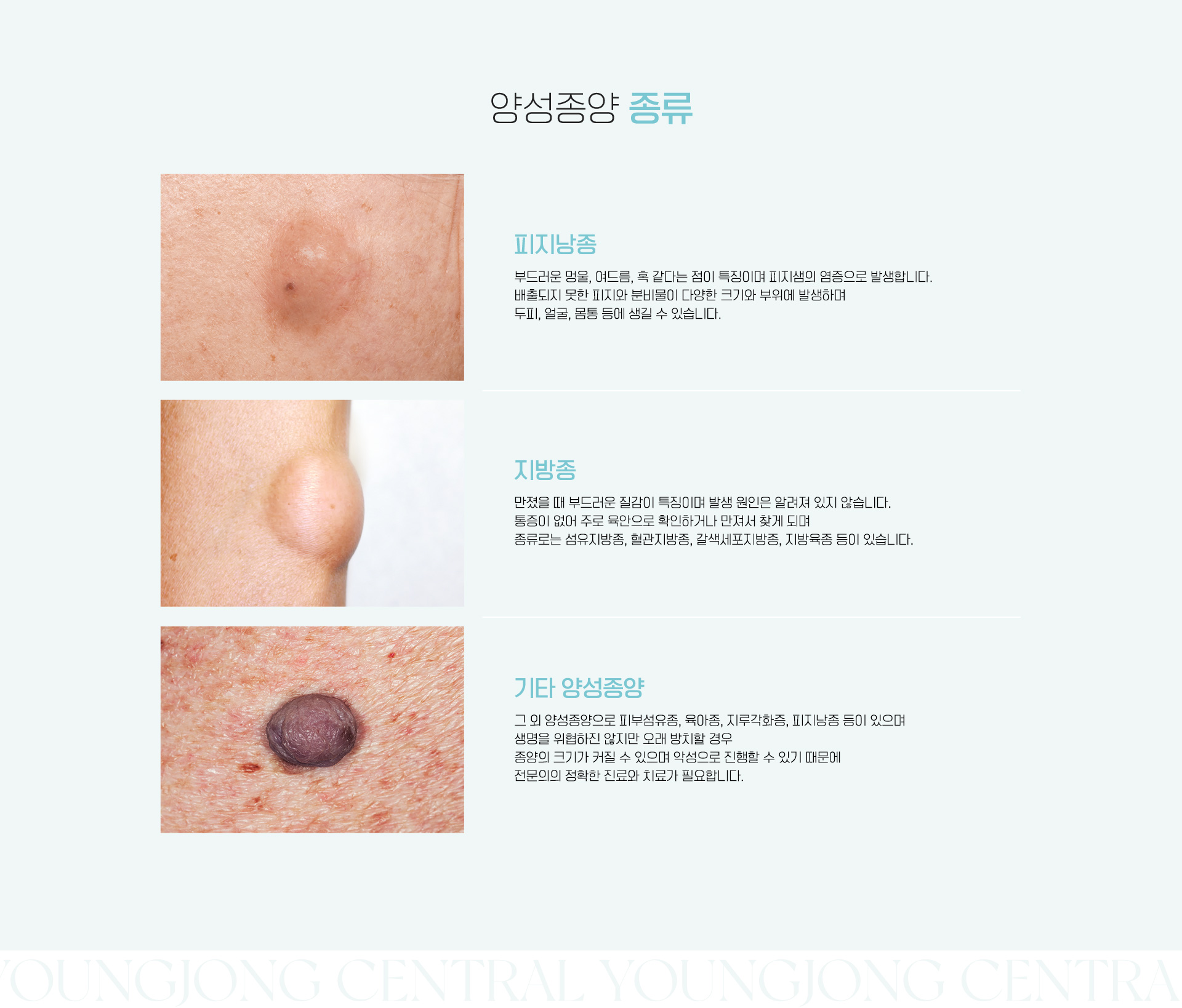 양성종양 종류