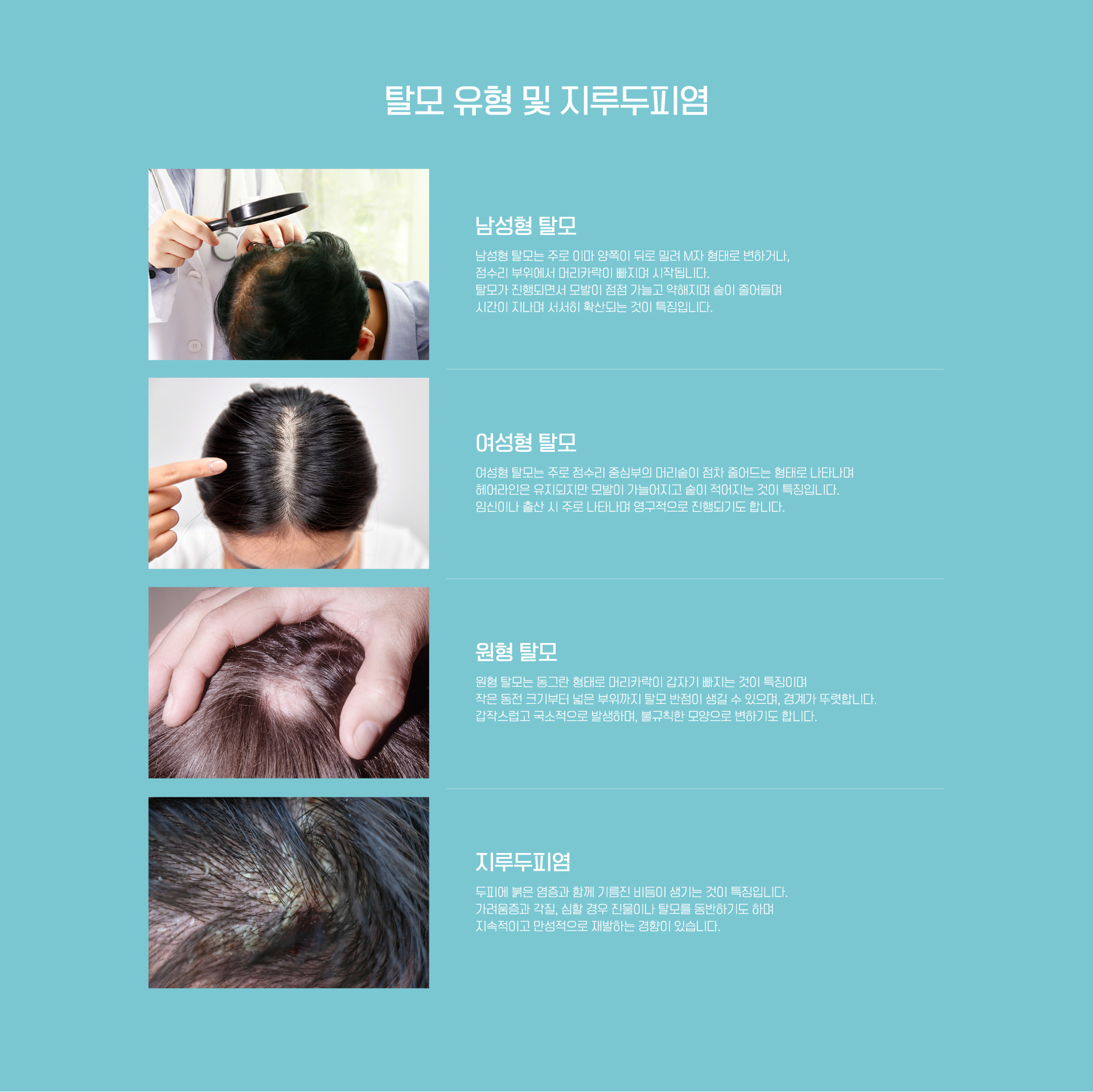 탈모 유형 및 지루두피염