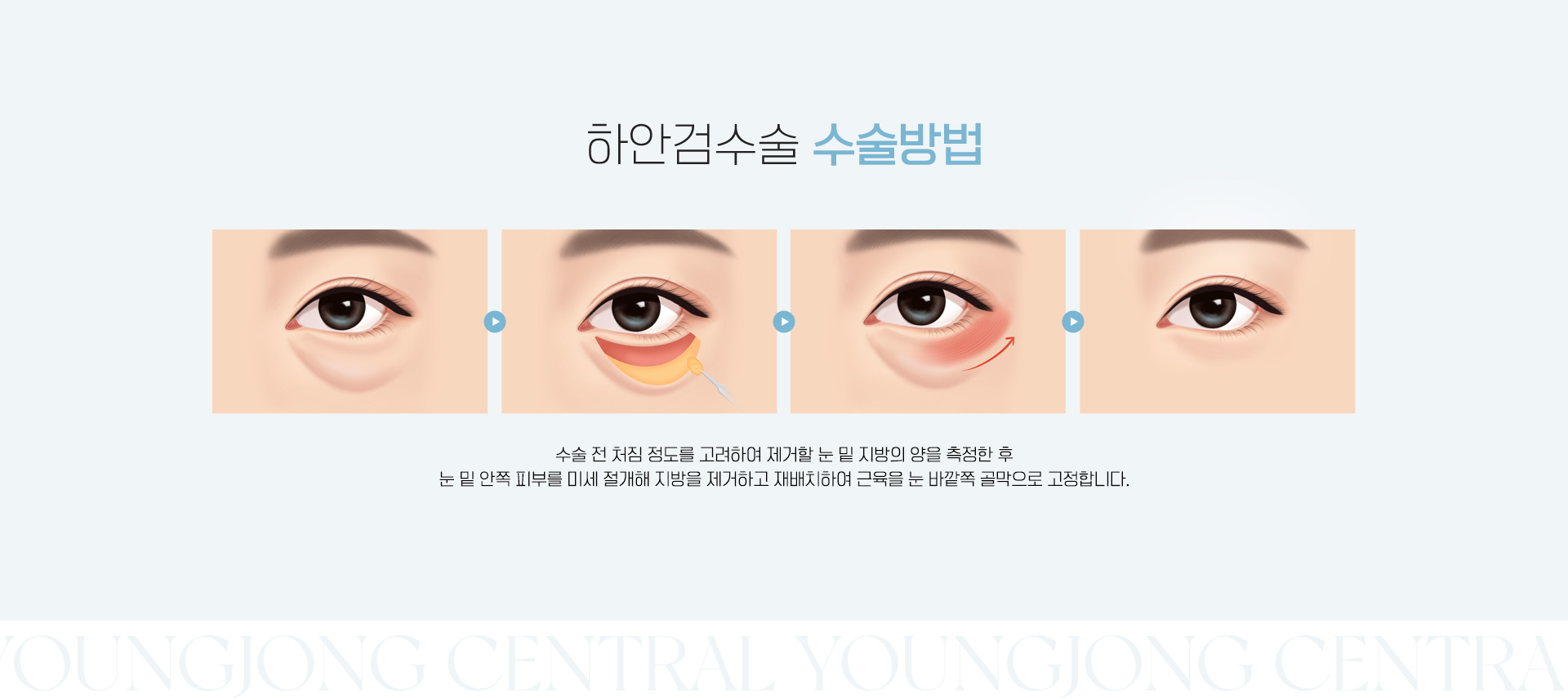 하안검수술 수술방법
