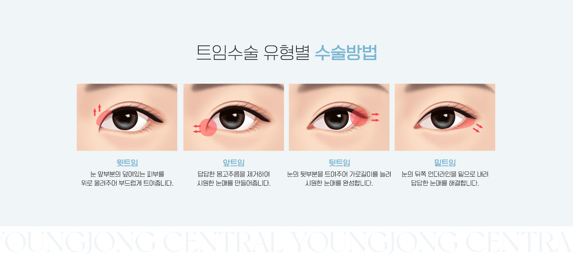 트임수술 수술방법